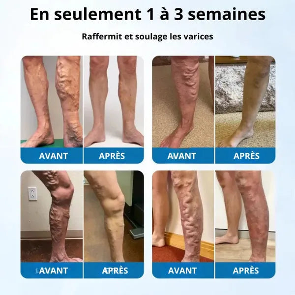 Spray réducteur de varices